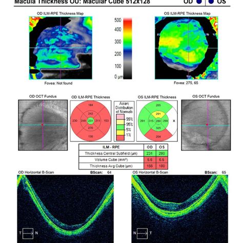 optical coherence tomography oct macular thickness analysis showed download scientific