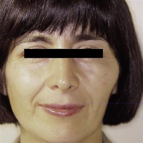 Facial Asymmetry Due To Left Cheek Swelling Download Scientific Diagram