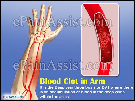 Blood Clot In Armsymptomstreatmenthome Remediesexercises