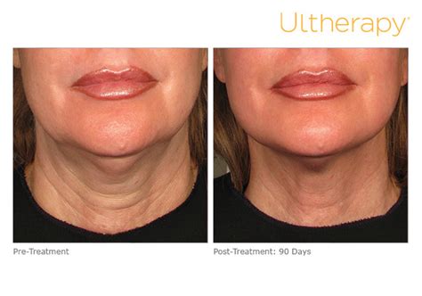 Ultherapy Nyc Tribeca Skin Center Face Tightening Lifting Non Surgical
