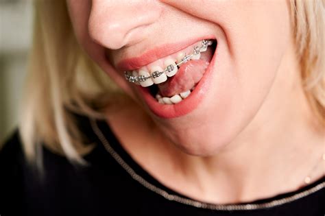 Using Spacers For Braces What You Need To Know
