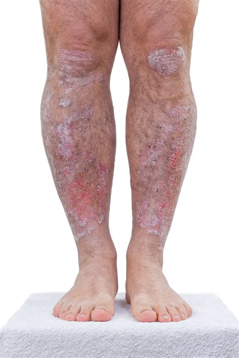 Psoriasis Causes And Treatment My Footdr