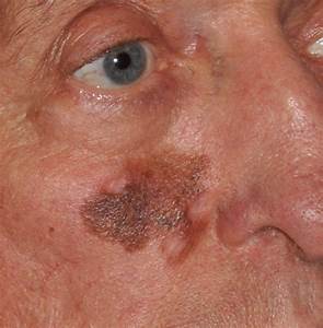 Facial Skin Cancer - Seattle Face & Skin Skin Cancer  