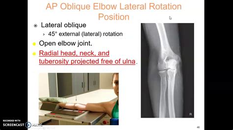 Elbow X Ray Protocol Youtube