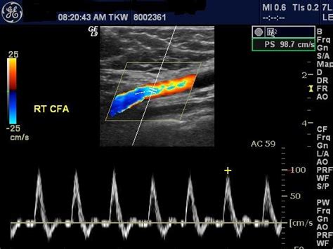 Cardiovascular Institute Of Michigan Arterial Doppler