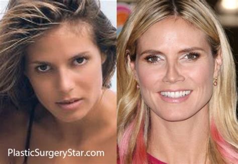 Heidi Klum Plastic Surgery Before And After Nose Job Celebrity Nose