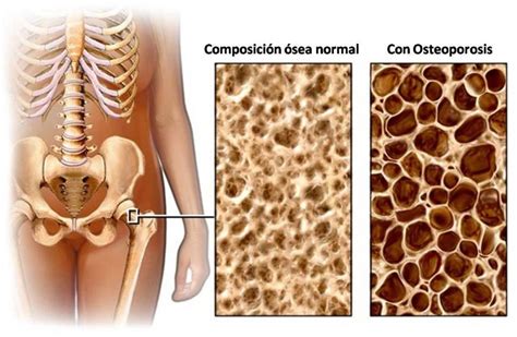 Osteoporosis Conoce los factores de riesgo y cómo prevenirla Chequeo
