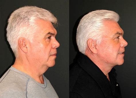 male facelift before and after dr andrew jacono
