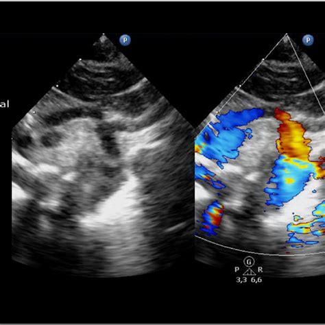 Schematic Representation Of Hypoplastic Left Heart Syndrome Note The