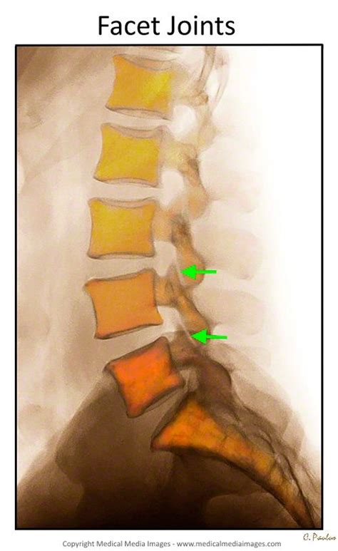 A Lateral Side View Color X Ray Of The Facet Joints Of The Lumbar