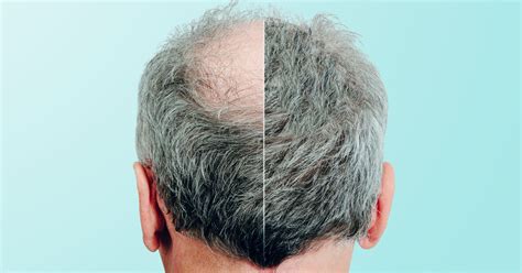 A few months after having a high fever or recovering from an illness, many people see noticeable hair loss. Alopecia: A deeper look at excessive hair loss - Vikram ...