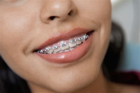 Affordable Braces In Fresno And Clovis Thurman Orthodontics