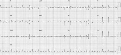 Atrial Flutter Litfl Ecg Library Diagnosis Hot Sex Picture
