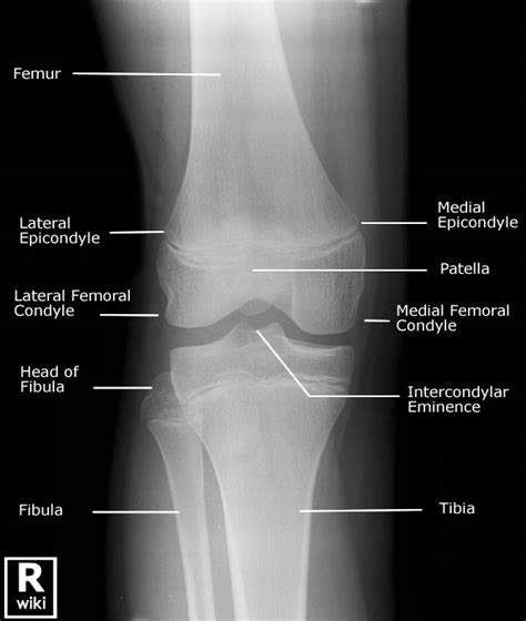 Paediatric Knee Wikiradiography