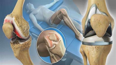 Cirurgia De Pr Tese De Joelho Cl Nica Do Joelho