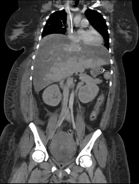 Coronal View Of The Patients Liver On A Ct Scan Demonstrating Marked