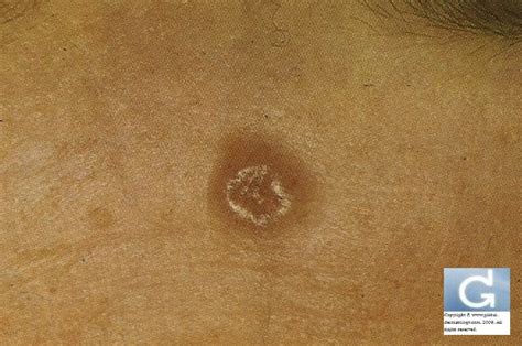 Basal Cell Carcinoma Bcc Premier Dermatology Atlanta Vrogue Co