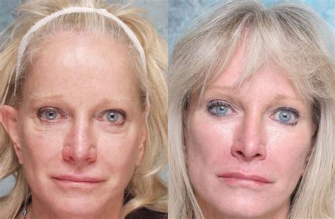 Almost everyone develops at least minor jowls as they age and their skin. How To Firm Up And Improve Sagging Face Skin Using Facial Yoga