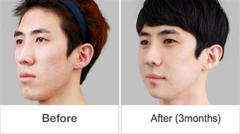 Real Story Korean Two Jaw Surgery Was The Right Solution For Him 짱이뻐