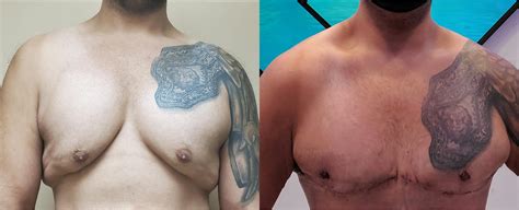 Severe Gynecomastia 3 Weeks Post Op Still Healing From Swelling And