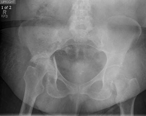 Ap Pelvis X Ray 13 Months Since Onset Of Symptoms And 15 Months