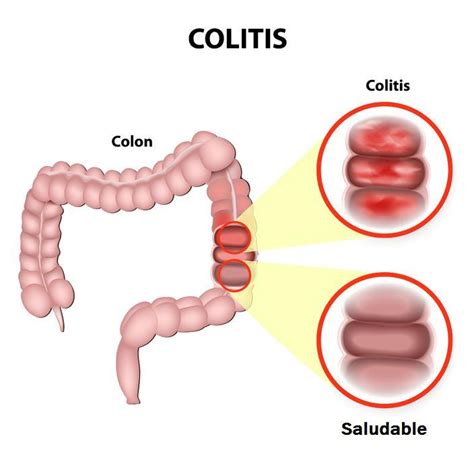 Colitis Qué Es Síntomas Tipos Tratamiento Características Y Más