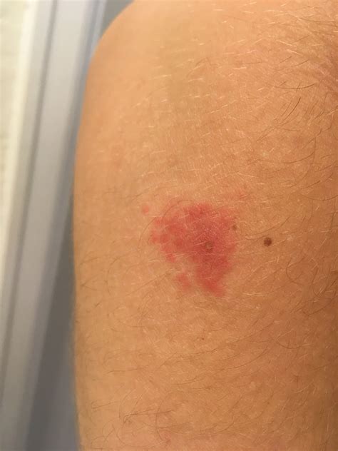 Mysterious Itchy Spots On My Arm