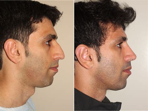 popular facial cosmetic procedures for men dr denton