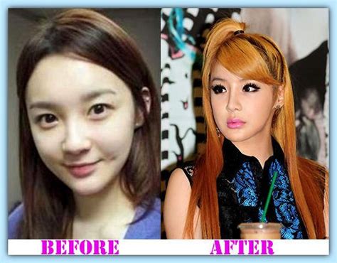 Park bom, a member of the korean band 2ne1, has had extensive plastic surgery procedures. Park Bom plastic surgery before and after Park Bom Plastic ...