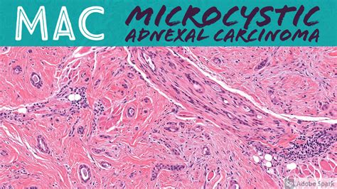 Microcystic Adnexal Carcinoma Mac Aip France 2021 Case 3 Video