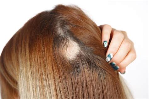 Alopeciahåravfall Ninfo