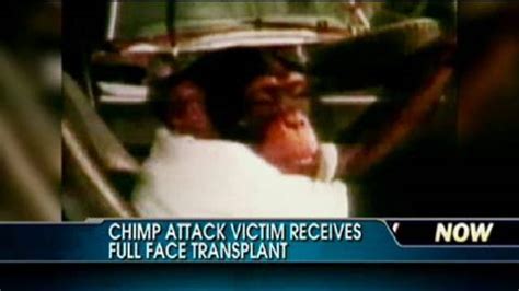 Chimp Attack Victim Receives Face Transplant Latest News Videos Fox News