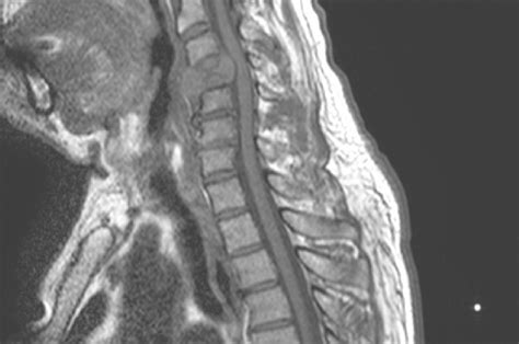 Sagittal View Of A T1 Weighted Magnetic Resonance Image Of The Cervical