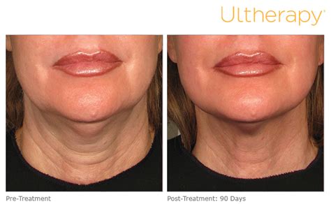 Ultherapy Jowls And Chin Rejuvalift Aesthetics