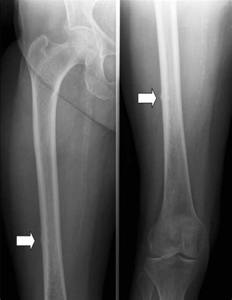 Femoral Shaft Stress Fractures Knee And Sports Orthobullets