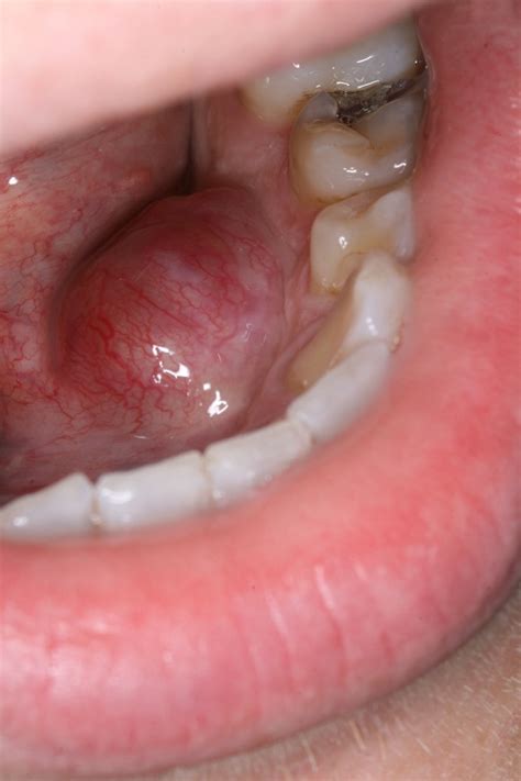 Floor Of Mouth Swollen After Tooth Extraction Home Alqu
