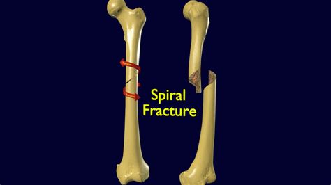 Spiral Fracture Of The Femur Causes Symptoms And Treatment Health News Website