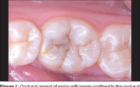 Figure 1 From Restoration Of Posterior Teeth Using Occlusal Matrix