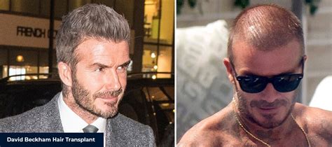 David Beckham Hair Transplant Smile Hair Clinic