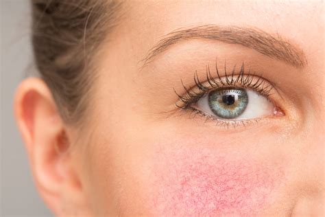 rosacea causes symptoms diagnosis and treatment telemed2u