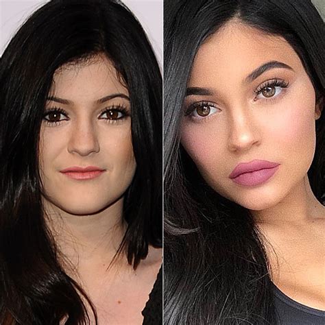 Before And After Did These Celebs Get Lip Injections Slice
