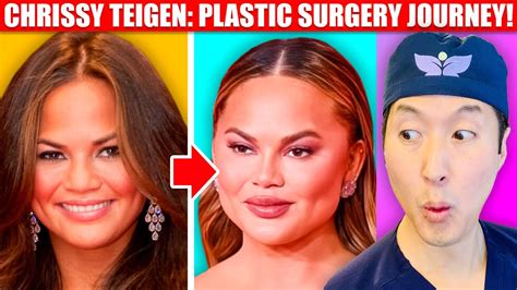 Plastic Surgeon Reacts To Chrissy Teigen Cosmetic Surgery