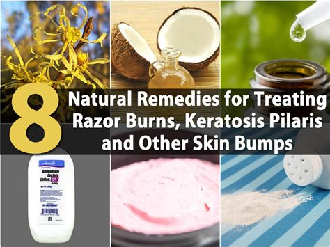 8 Natural Remedies For Treating Razor Burns Keratosis Pilaris And