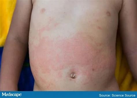 Nightly Fever Swollen Lymph Nodes And Rash In A 3 Year Old Swollen