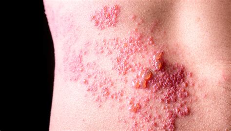 What Does Shingles Look Like Lifemd