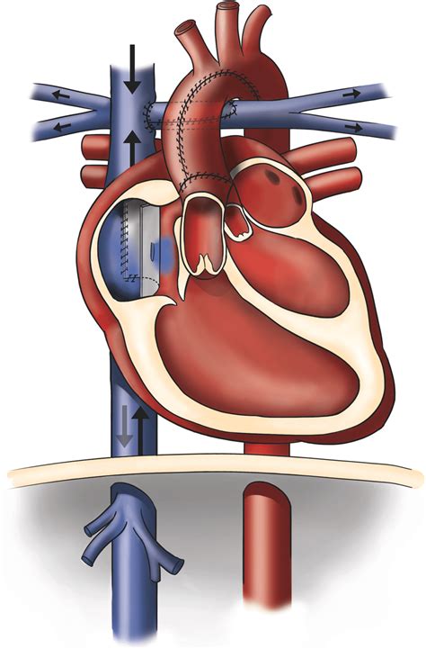 Schematic Drawing Of The Fontan Circulation As Established In A Patient