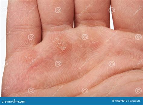 Injured Palm Hand Stock Photo Image Of Blisters Hand 126274216