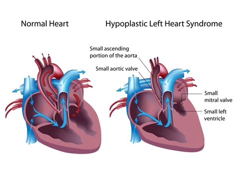 산전진단 Cystic Hygroma 낭포성히그로마 네이버 블로그