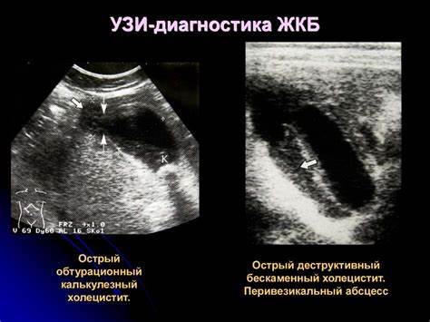 Желчнокаменная болезнь. Острый холецистит - презентация онлайн Картинка - Желчнокаменная болезнь. Острый холецистит - презентация онлайн