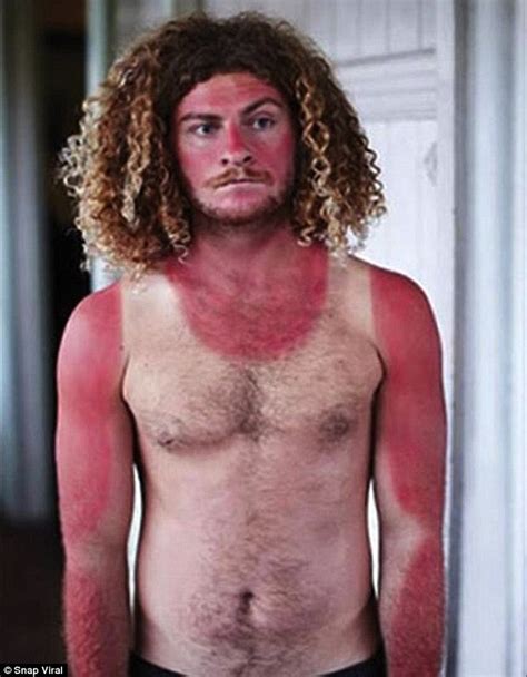 Sunburn Images Show Epic Tan Fails And Bruised Egos To Match Big